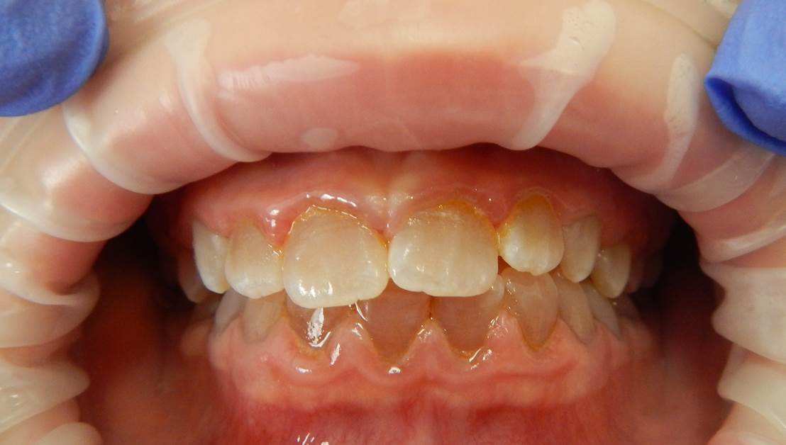 ex de photoendobuccale petite